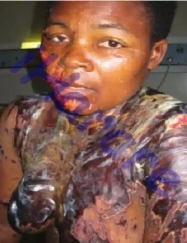 Wicked & Ugly Pastor Pours Acid On His Ex Lover For Dumping Him In Zimbabwe [See Photos]